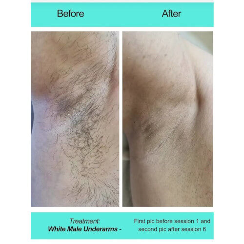 Before and After picture of Armpits